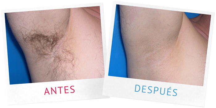 Depilacion definitiva cavado online antes y despues